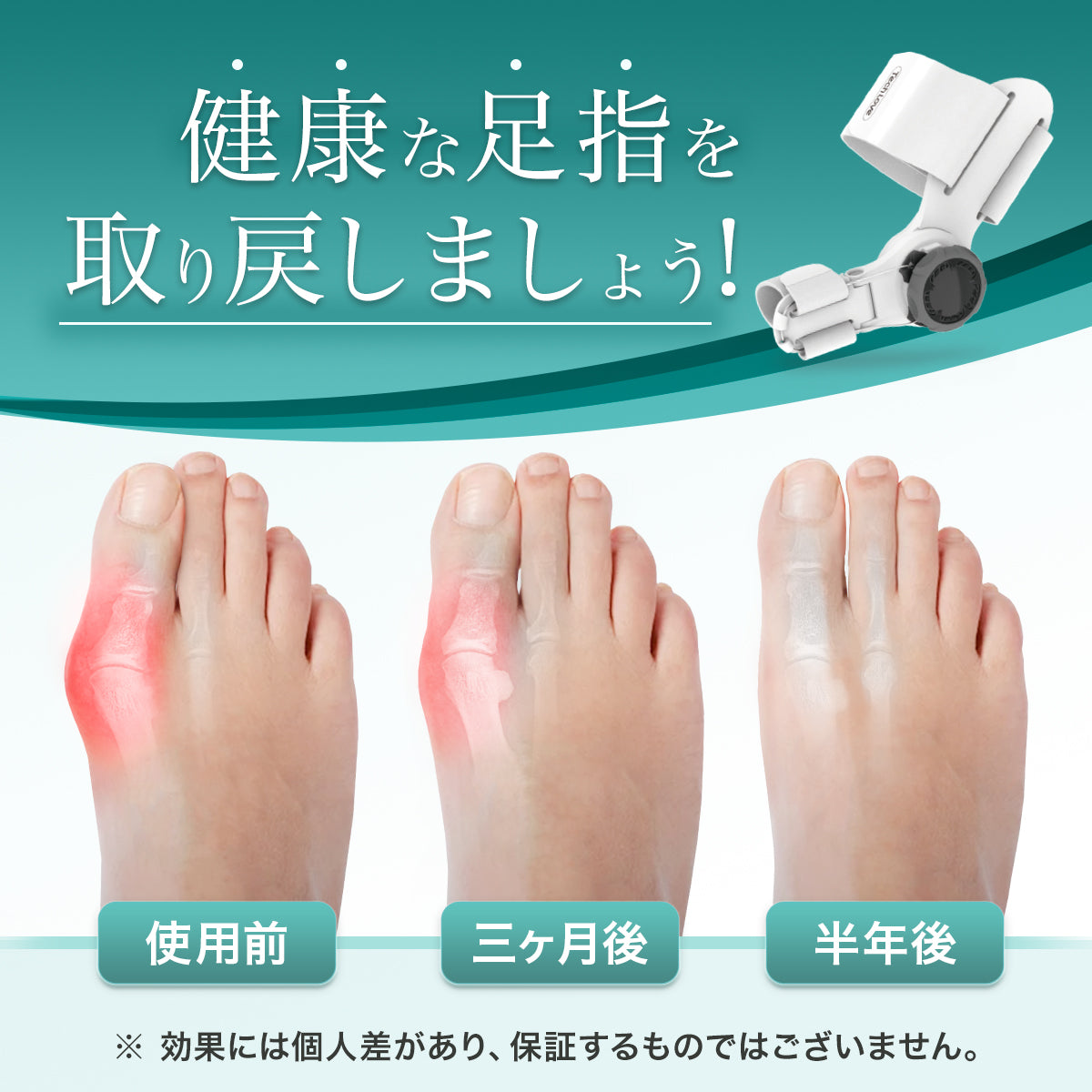 Tech Love ダイヤル式外反セパレーター外反母趾サポーター　2個 自宅用+外出用 3in1セット】Tech Love 外反母趾矯正グッズ